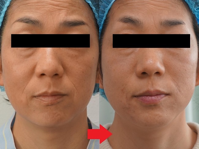 专门针对改善脸部皱纹的最新型玻尿酸注射voliftxc